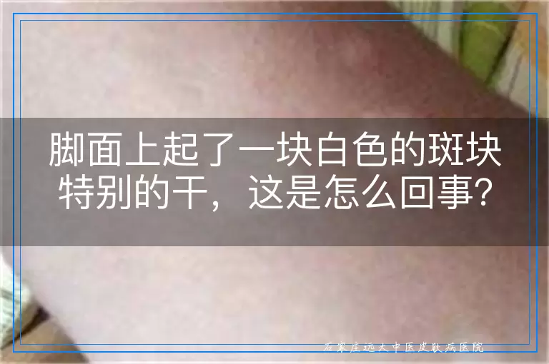 脚面上起了一块白色的斑块特别的干，这是怎么回事？