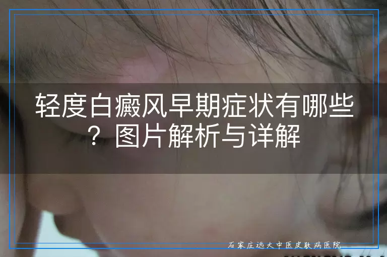 轻度白癜风早期症状有哪些？图片解析与详解