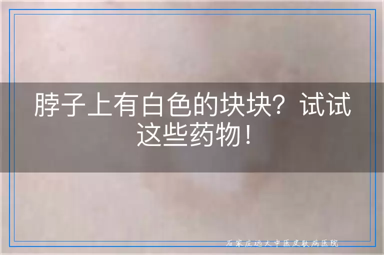 脖子上有白色的块块？试试这些药物！
