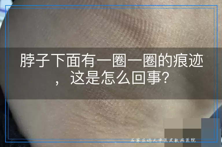 脖子下面有一圈一圈的痕迹，这是怎么回事？