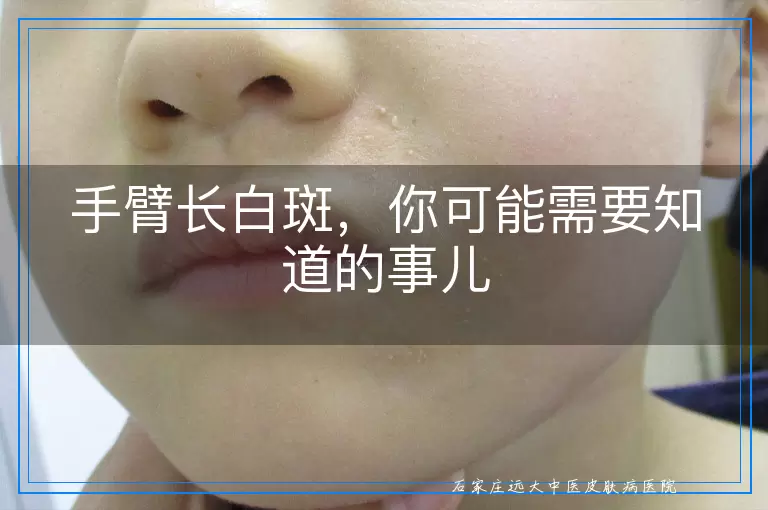 手臂长白斑，你可能需要知道的事儿