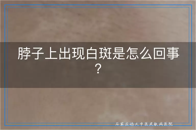 脖子上出现白斑是怎么回事？
