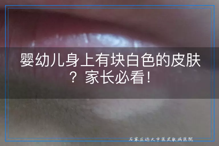 婴幼儿身上有块白色的皮肤？家长必看！