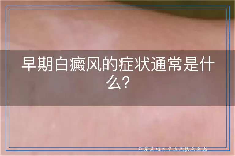 早期白癜风的症状通常是什么？