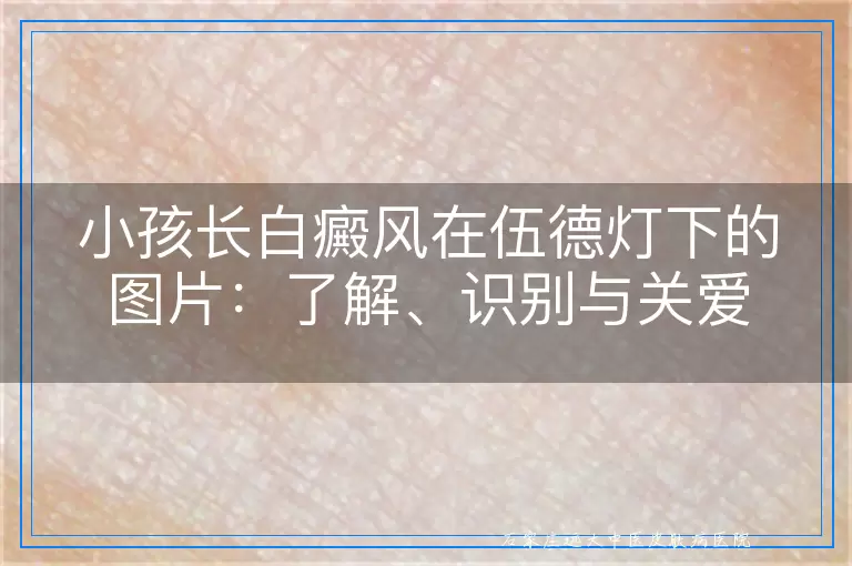 小孩长白癜风在伍德灯下的图片：了解、识别与关爱