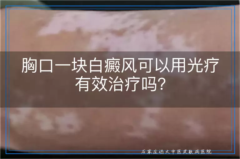 胸口一块白癜风可以用光疗有效治疗吗？