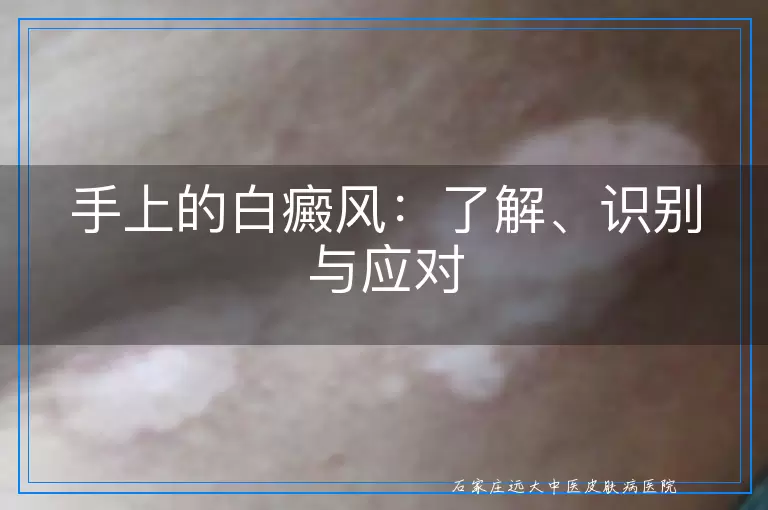 手上的白癜风：了解、识别与应对