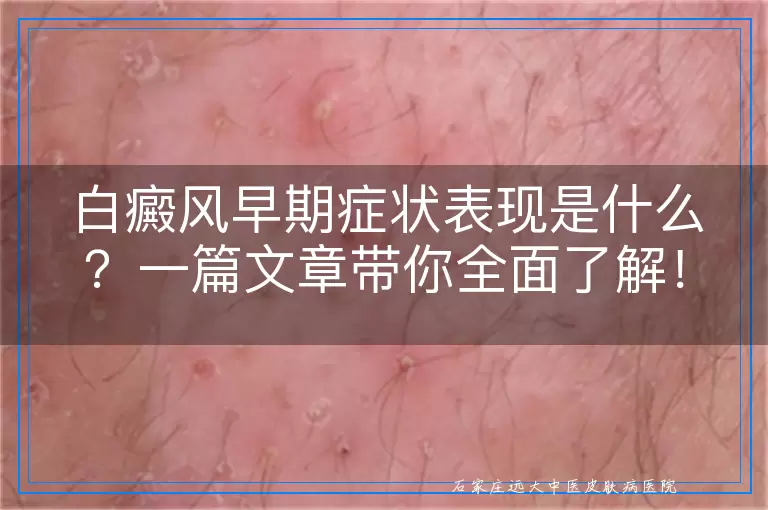 白癜风早期症状表现是什么？一篇文章带你全面了解！