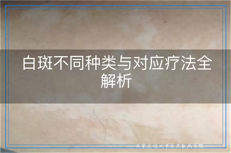 白斑不同种类与对应疗法全解析