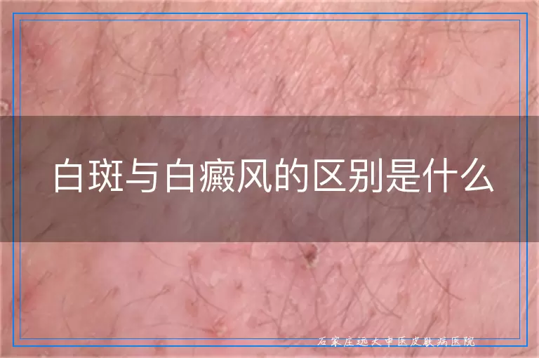 白斑与白癜风的区别是什么