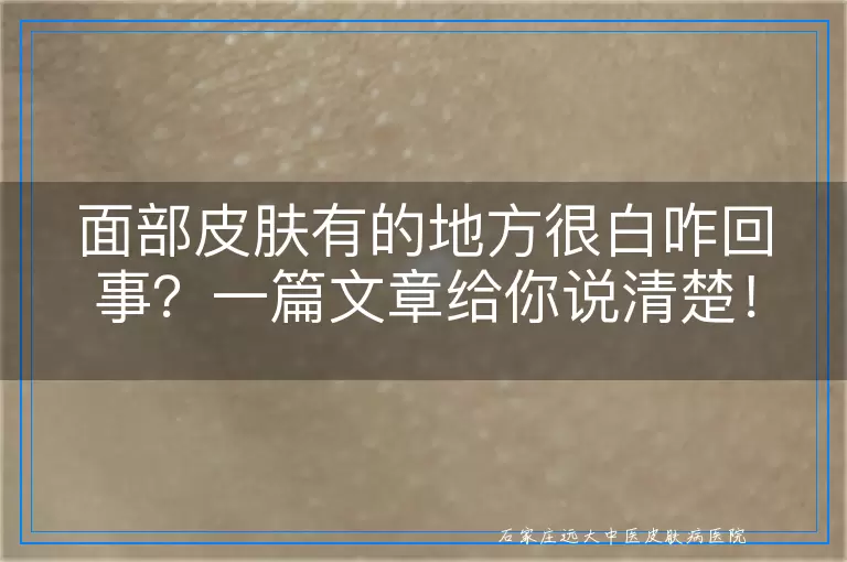 面部皮肤有的地方很白咋回事？一篇文章给你说清楚！