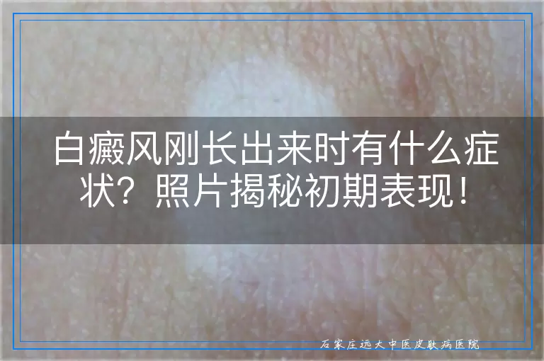 白癜风刚长出来时有什么症状？照片揭秘初期表现！
