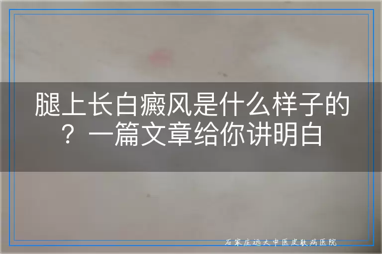 腿上长白癜风是什么样子的？一篇文章给你讲明白