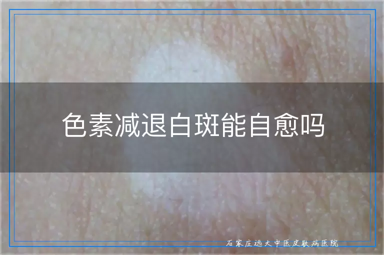 色素减退白斑能自愈吗