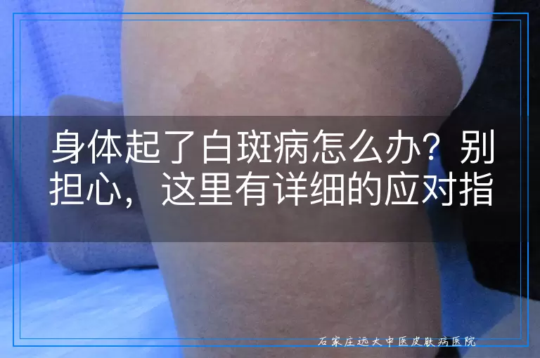 身体起了白斑病怎么办？别担心，这里有详细的应对指南！