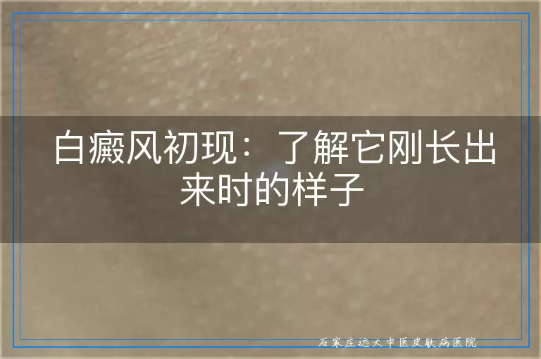 白癜风初现：了解它刚长出来时的样子