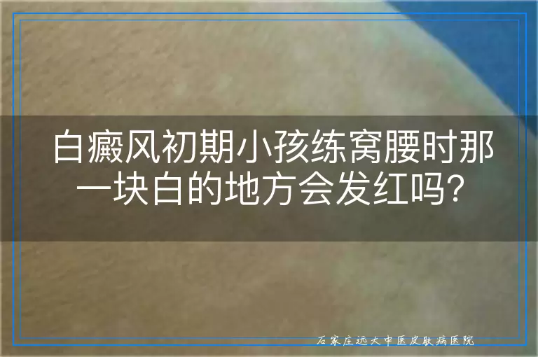 白癜风初期小孩练窝腰时那一块白的地方会发红吗？