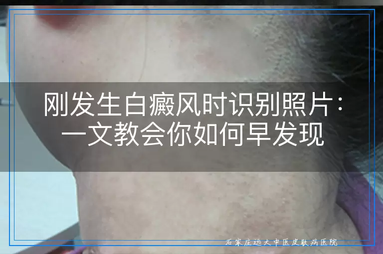 刚发生白癜风时识别照片：一文教会你如何早发现
