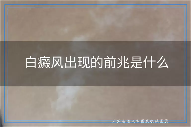 白癜风出现的前兆是什么