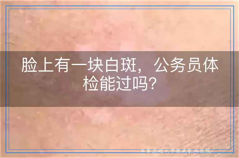脸上有一块白斑，公务员体检能过吗？