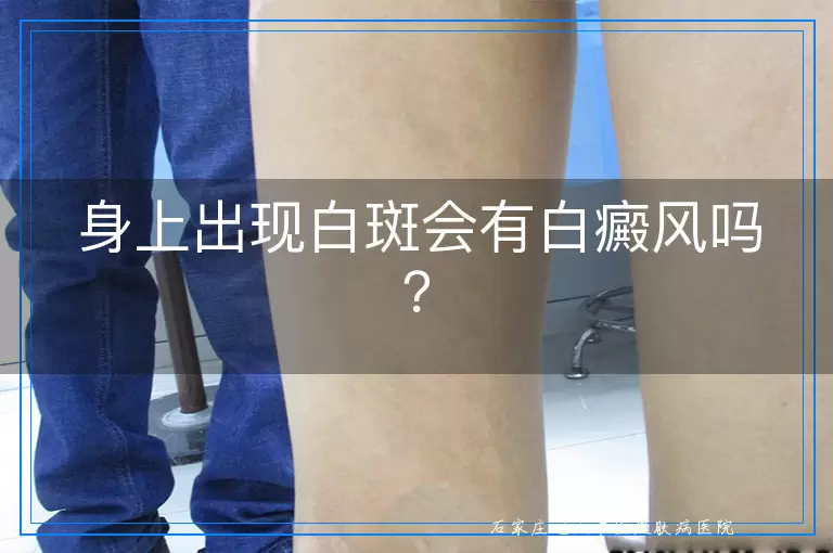身上出现白斑会有白癜风吗？