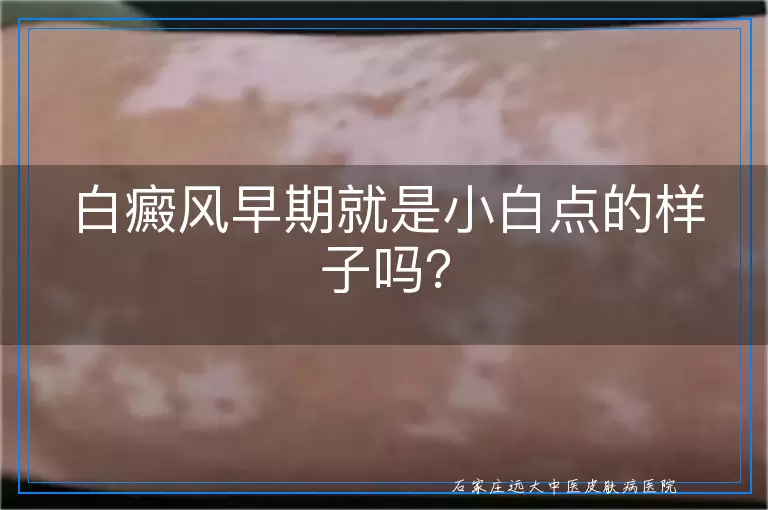 白癜风早期就是小白点的样子吗？