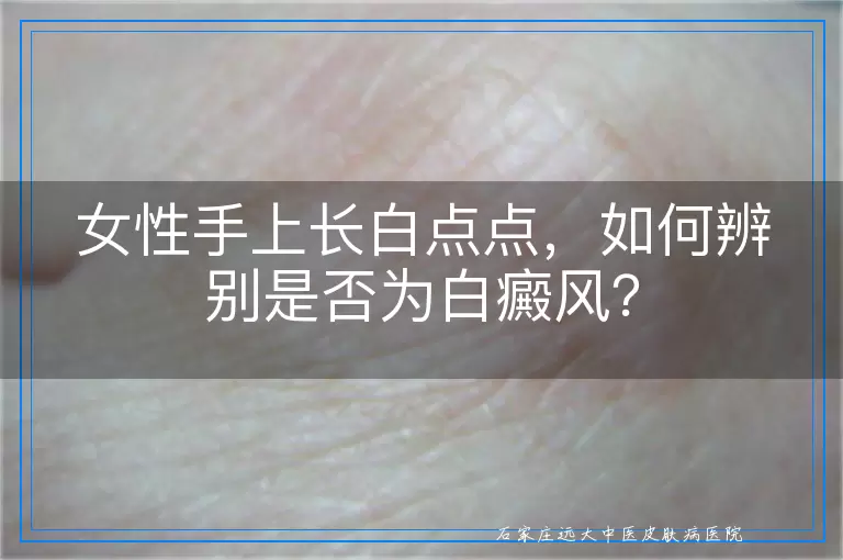 女性手上长白点点，如何辨别是否为白癜风？