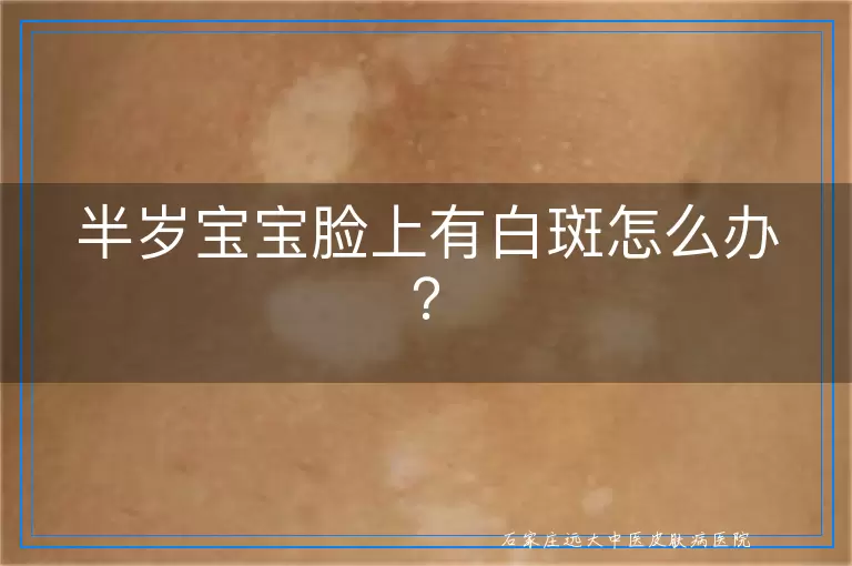 半岁宝宝脸上有白斑怎么办？