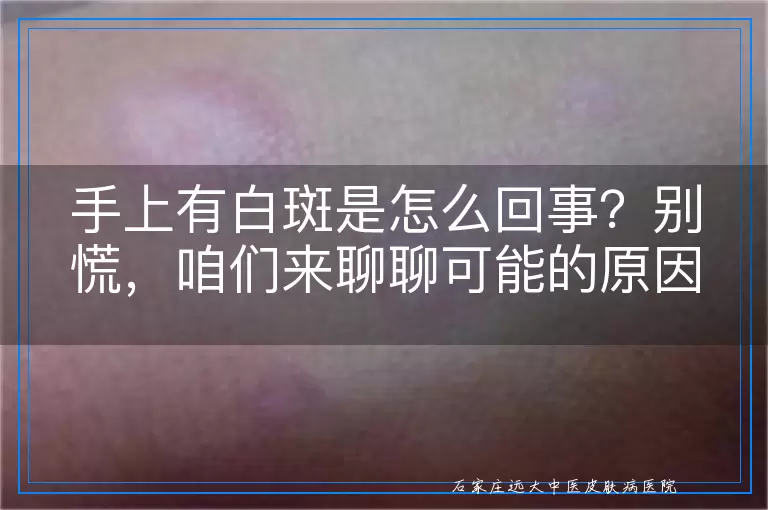 手上有白斑是怎么回事？别慌，咱们来聊聊可能的原因