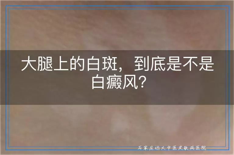 大腿上的白斑，到底是不是白癜风？
