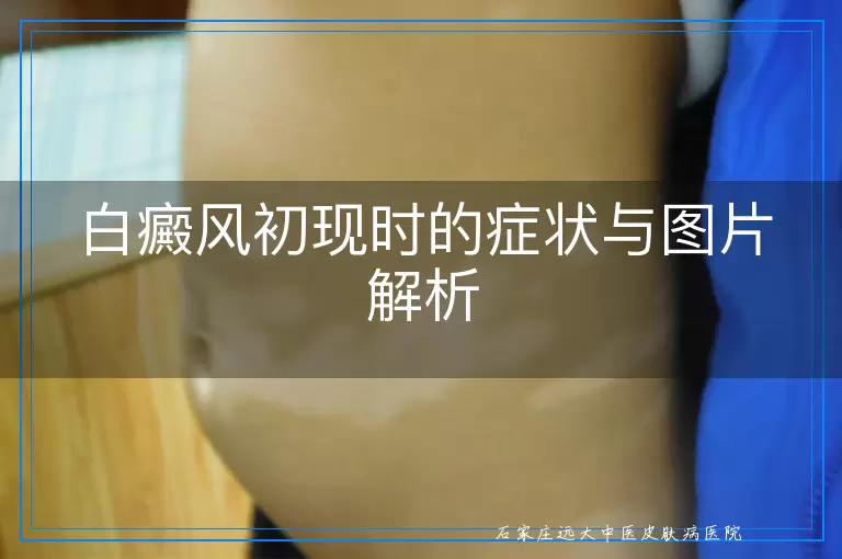 白癜风初现时的症状与图片解析