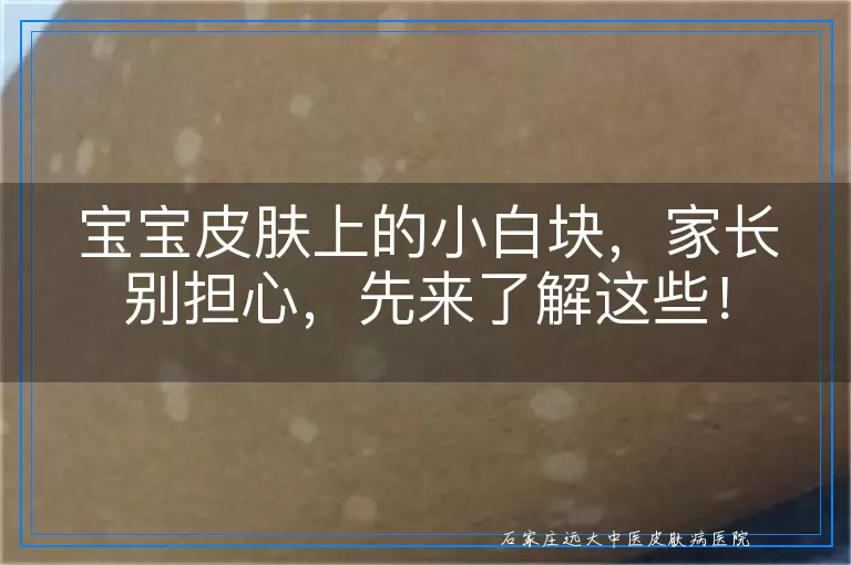 宝宝皮肤上的小白块，家长别担心，先来了解这些！