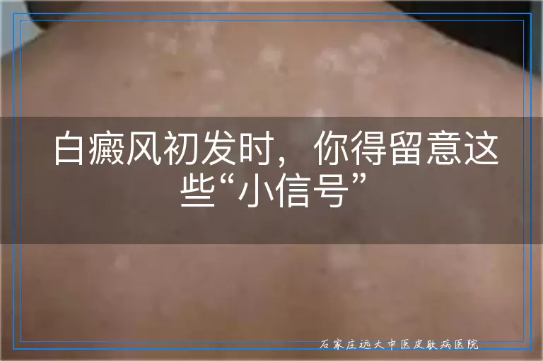 白癜风初发时，你得留意这些“小信号”