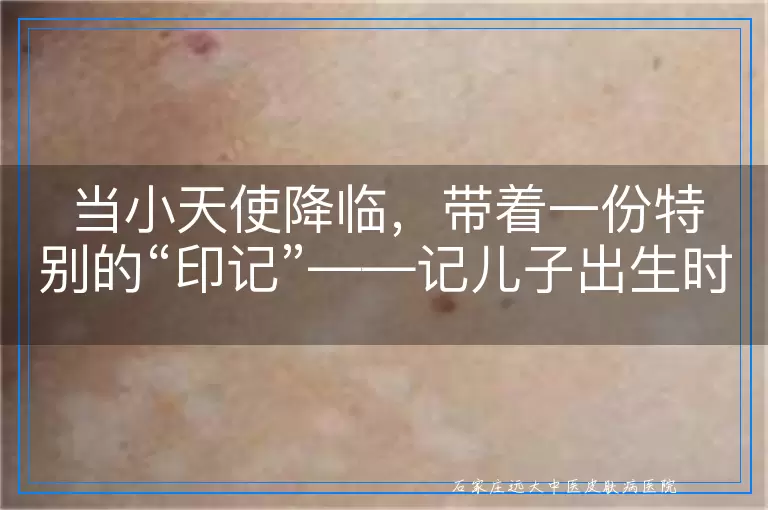 当小天使降临，带着一份特别的“印记”——记儿子出生时肚子上的大块白斑