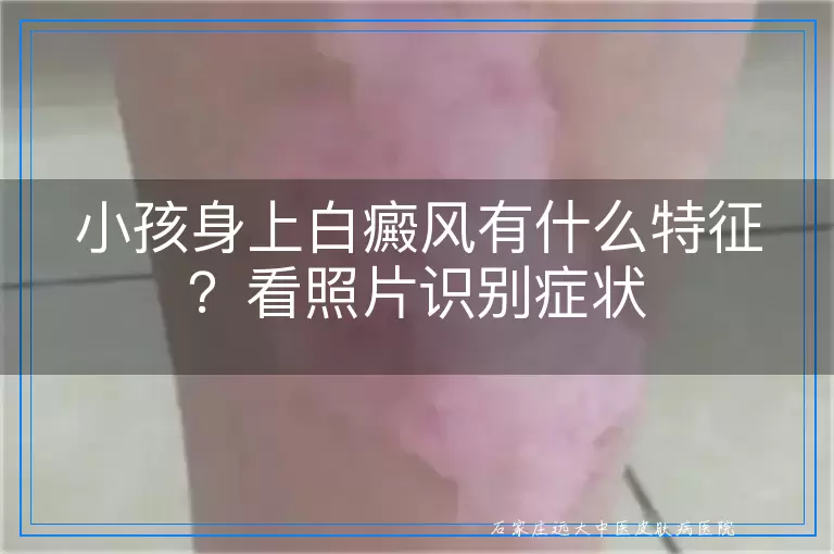 小孩身上白癜风有什么特征？看照片识别症状