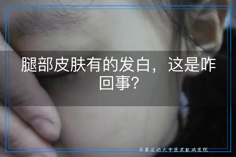 腿部皮肤有的发白，这是咋回事？