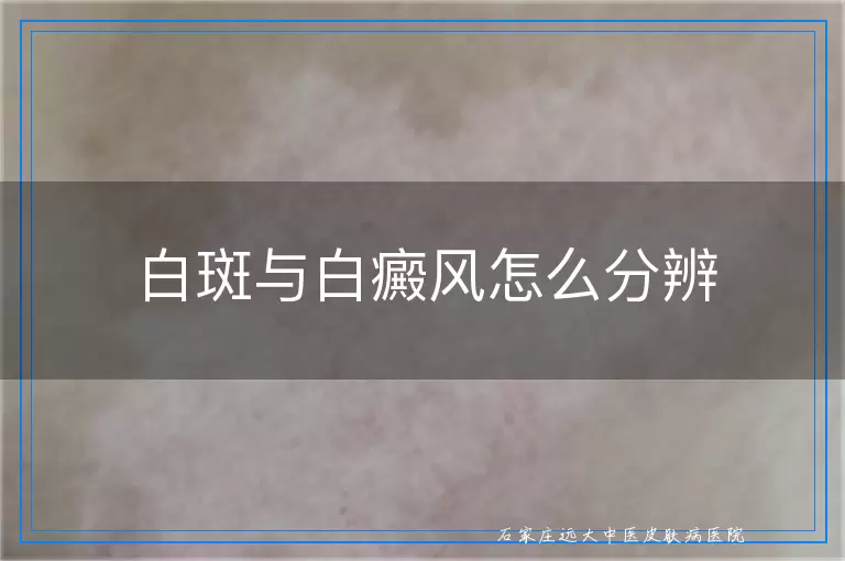 白斑与白癜风怎么分辨