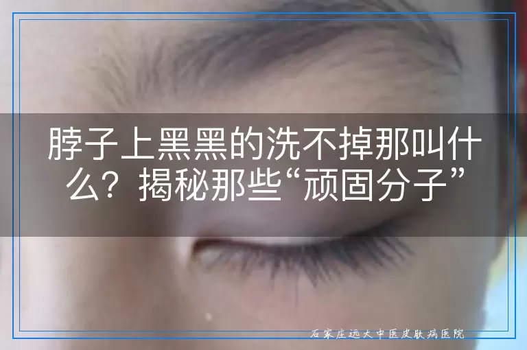 脖子上黑黑的洗不掉那叫什么？揭秘那些“顽固分子”