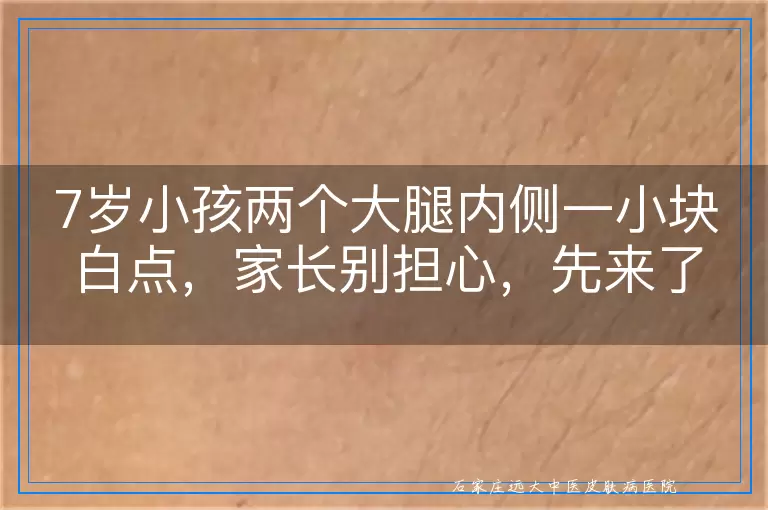 7岁小孩两个大腿内侧一小块白点，家长别担心，先来了解这些