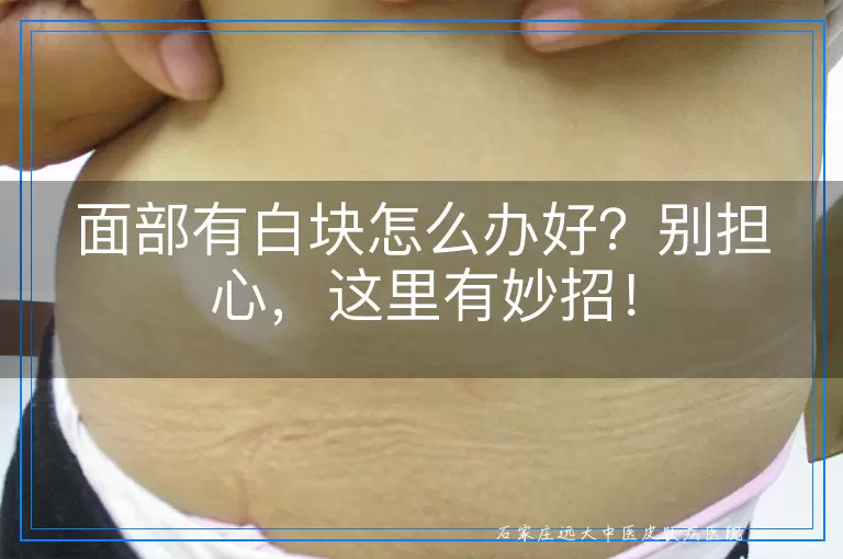 面部有白块怎么办好？别担心，这里有妙招！