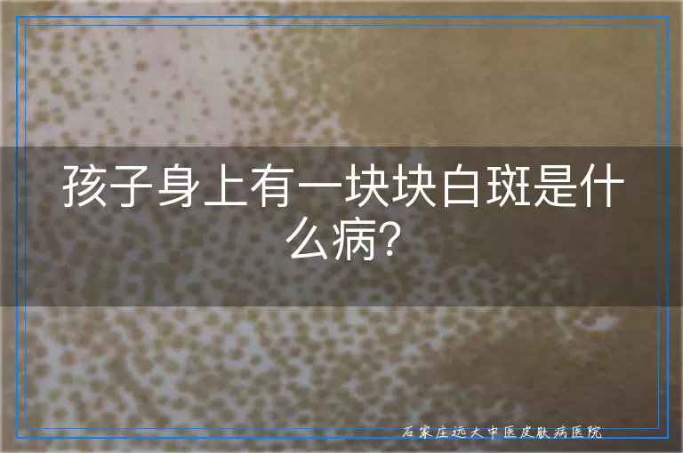 孩子身上有一块块白斑是什么病？