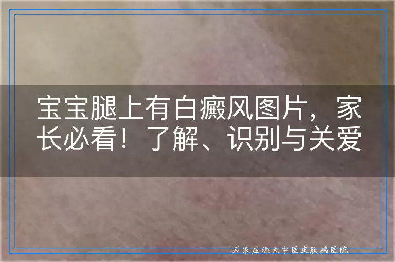 宝宝腿上有白癜风图片，家长必看！了解、识别与关爱