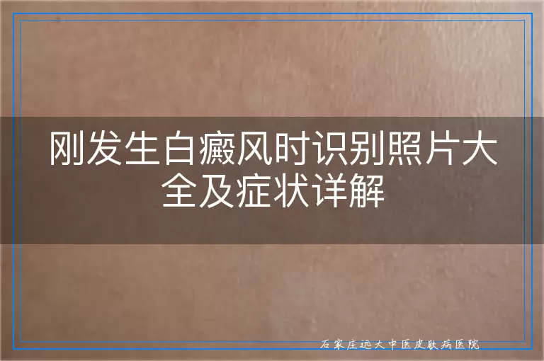 刚发生白癜风时识别照片大全及症状详解