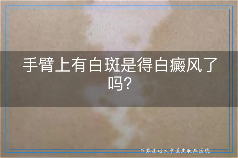 手臂上有白斑是得白癜风了吗？