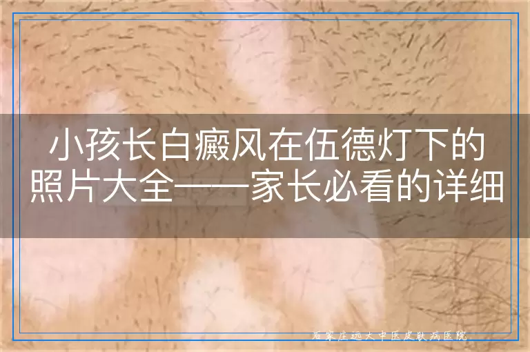 小孩长白癜风在伍德灯下的照片大全——家长必看的详细解析