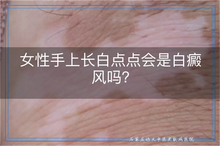 女性手上长白点点会是白癜风吗？