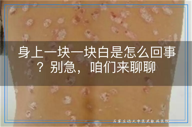 身上一块一块白是怎么回事？别急，咱们来聊聊