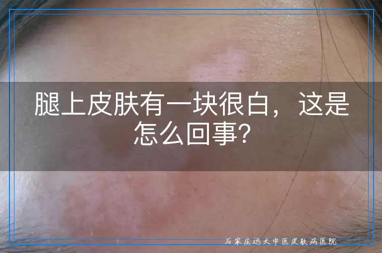 腿上皮肤有一块很白，这是怎么回事？