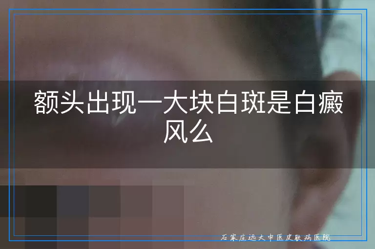 额头出现一大块白斑是白癜风么