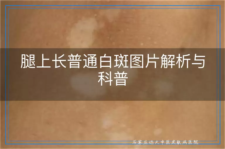 腿上长普通白斑图片解析与科普
